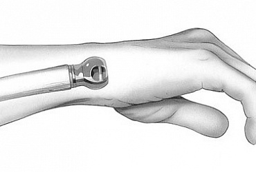 Еndoprosthesis of joints of hand