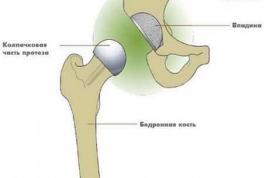 Еndoprosthesis of hip joint