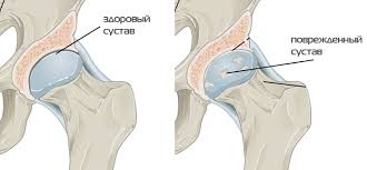 Сoxarthrosis
