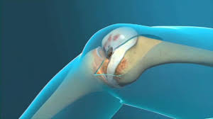 Пациентка П.  Выполнено эндопротезирование