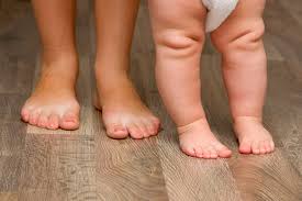 Clubfoot