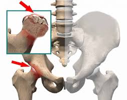 Aseptische nekrose des hüftkopfes