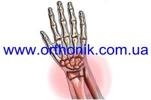 Bruch der Knochen der Hand