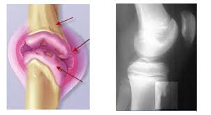 Osgood Schlatter-Krankheit