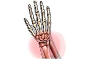 Перелом костей кисти
