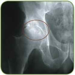 Primary coxarthrosis.jpg Primary coxarthrosis.jpg