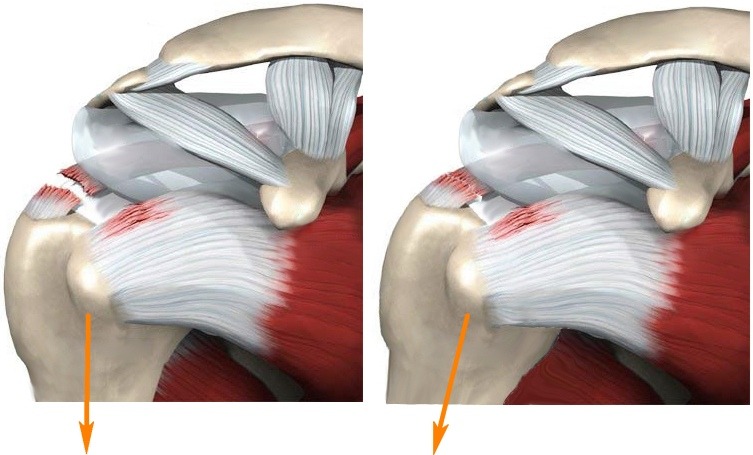 Arthroscopy of the shoulder joint3.jpg Arthroscopy of the shoulder joint3.jpg