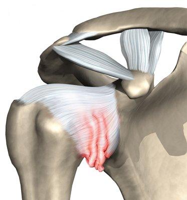 Arthroscopy of the shoulder joint4.jpg Arthroscopy of the shoulder joint4.jpg