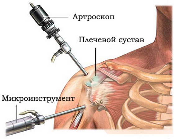 Arthroscopy of the shoulder joint5.jpg Arthroscopy of the shoulder joint5.jpg