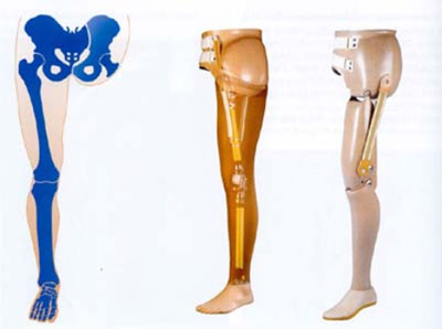 Prothese für die Artikulation im Hüftgelenk.jpg