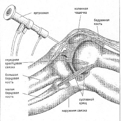 Arthroscopy of the knee joint2.jpg Arthroscopy of the knee joint2.jpg