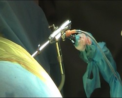 Эндоскопическая операция удаления межпозвонковой грыжи поясничного отдела.jpg