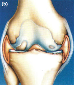Arthroscopy of the knee joint4.jpg Arthroscopy of the knee joint4.jpg