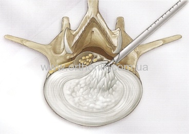Foraminoscopy1.jpg Foraminoscopy1.jpg
