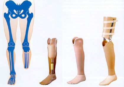 Prothesen des Unterschenkels.jpg