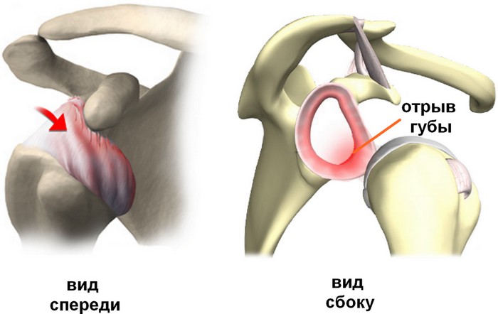 Arthroscopy of the shoulder joint2.jpg Arthroscopy of the shoulder joint2.jpg