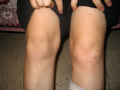 Arthroscopy of the knee joint6.jpg Arthroscopy of the knee joint6.jpg