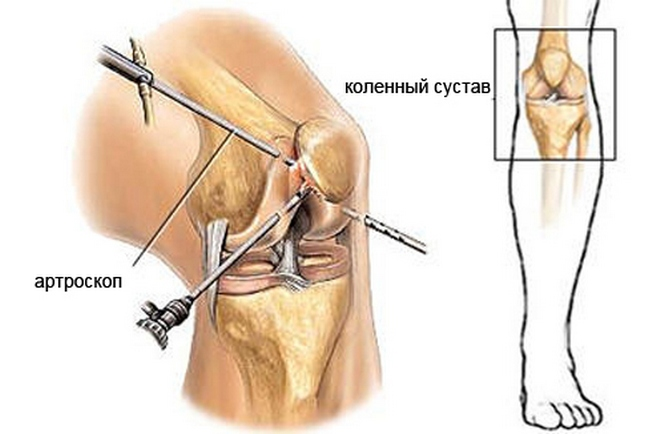 Arthroscopy of the knee joint1.png Arthroscopy of the knee joint1.png