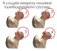 Aseptische nekrose des hüftkopfes