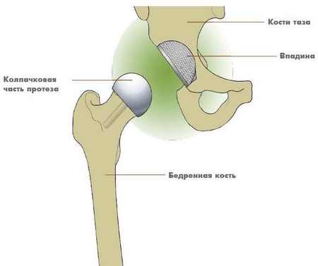 Еndoprosthesis of hip joint Еndoprosthesis of hip joint