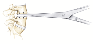 Удаление грыжи 