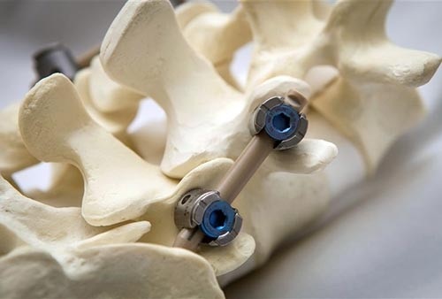 Spinal stabilization Spinal stabilization