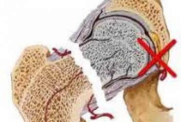 Перелом шейки бедра 