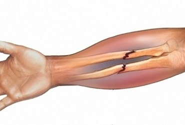 Fraktur der Unterarmknochen