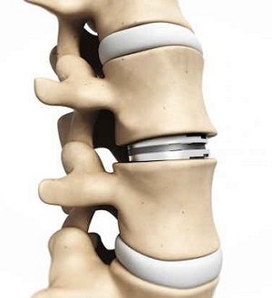 Entfernung einer Hernie