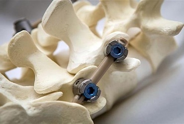 Stabilisierung der Wirbelsäule