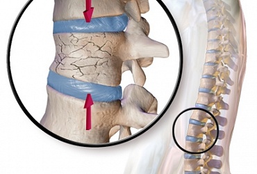 Kyphoplasty