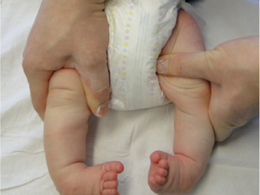Clubfoot Clubfoot