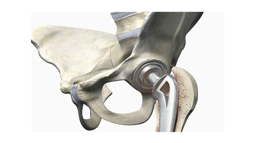 Artificial hip joint Artificial hip joint