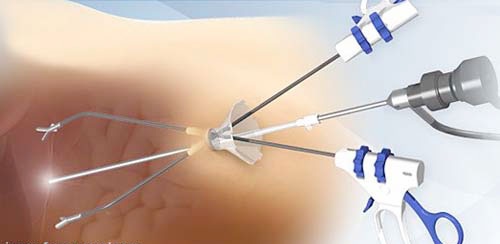 Laparoscopic operation Laparoscopic operation