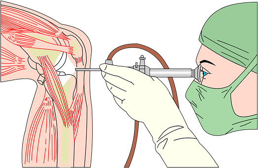 Аrthroscopy of knee joint Аrthroscopy of knee joint