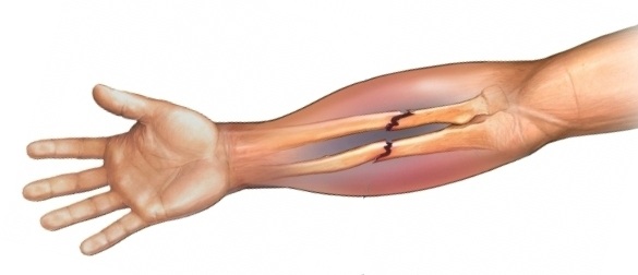 Forearm fracture  Forearm fracture