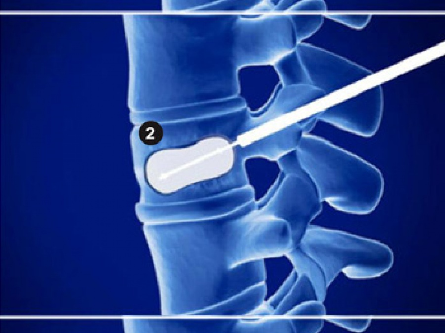 Кифопластика