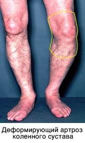 Gonarthrosis