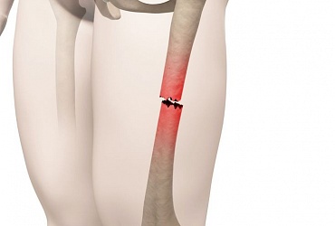 Перелом тела бедренной кости