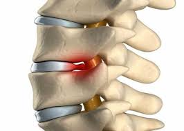 Microdiscectomy Microdiscectomy