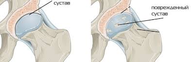 Коксартроз (артроз тазобедренного сустава)