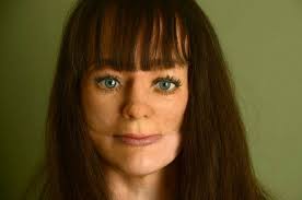 Протез носа и части верхней челюсти (мягких тканей)