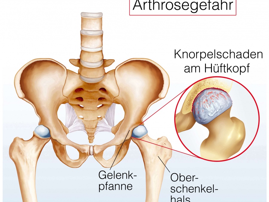 Coxarthrose (Arthrose des Hüftgelenks)