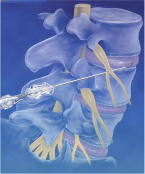 Epidural neurolysis (Racz procedure) Epidural neurolysis (Racz procedure)