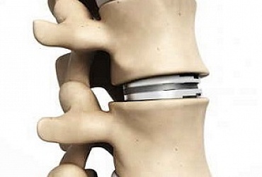 Hernia excision