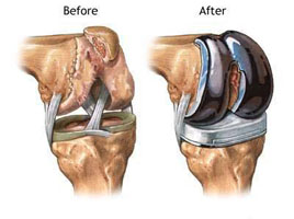 Endoprothetik des Kniegelenks