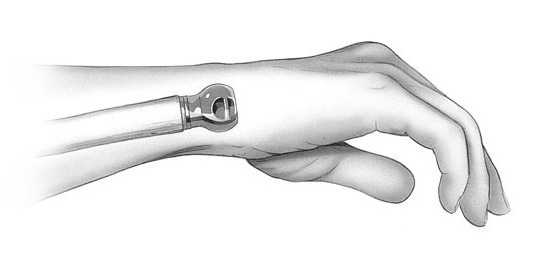 Endoprothetik der Gelenke der Hand