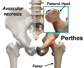 Perthes disease Perthes disease