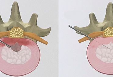 Transplantation von autologen Zellen der Bandscheibe (ADCT)