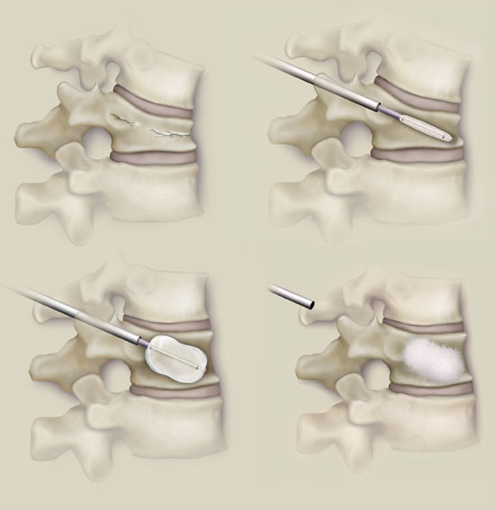 Kyphoplasty Kyphoplasty